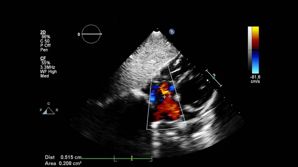 Immagine Del Cuore Durante Ecografia Transesofagea Con Modalità Doppler — Foto Stock