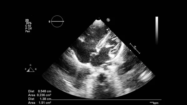 Transesofageal Ultrason Sırasında Kalbin Gri Ölçekli Görüntüsü — Stok fotoğraf