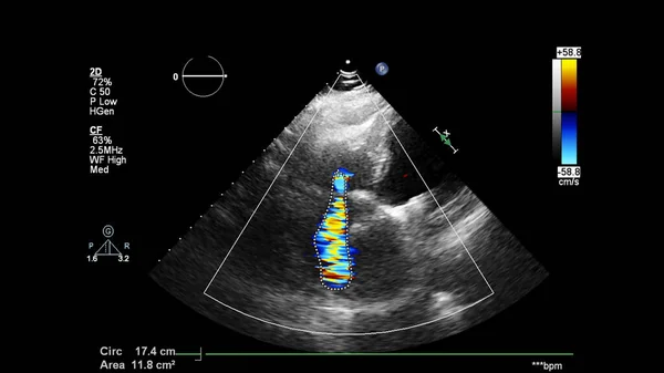 Imagen Del Corazón Durante Ecografía Transesofágica Con Modo Doppler — Foto de Stock