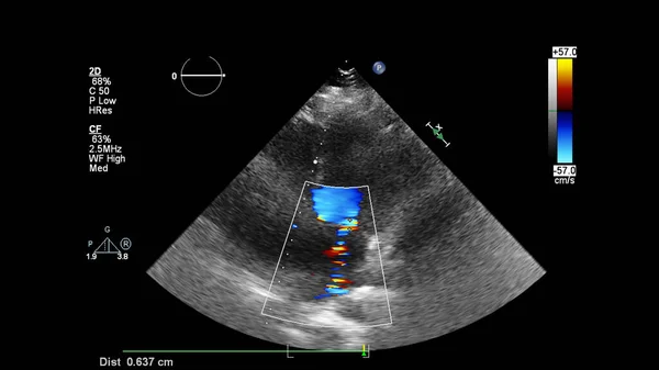 Image Cœur Lors Une Échographie Transœsophagienne Mode Doppler — Photo