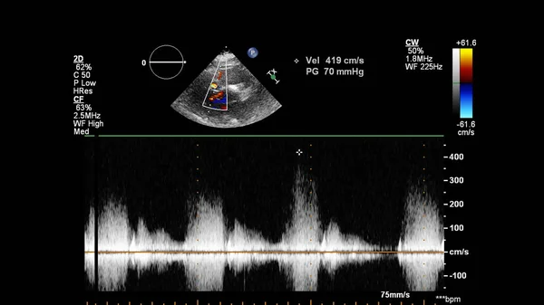 Transesofageal Ultrason Sırasında Doppler Kipi Ile Kalbin Görüntüsü — Stok fotoğraf