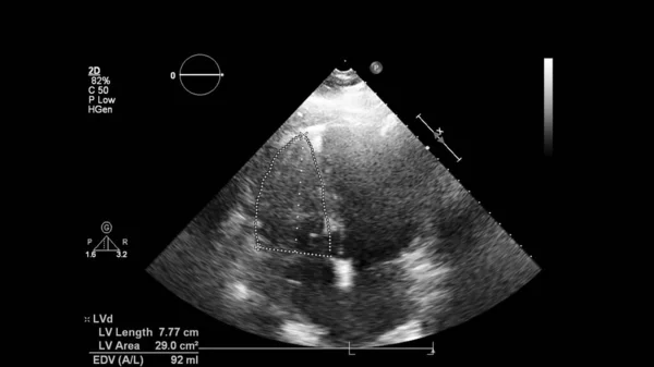 Transesofageal Ultrason Sırasında Kalbin Gri Ölçekli Görüntüsü — Stok fotoğraf