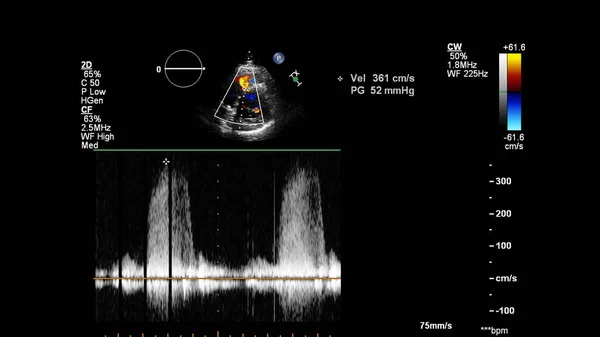 Imagen Del Corazón Durante Ecografía Transesofágica Con Modo Doppler — Foto de Stock