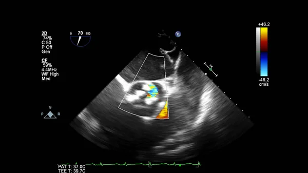 Bild Des Herzens Beim Transesophagealen Ultraschall Mit Doppler Modus — Stockfoto