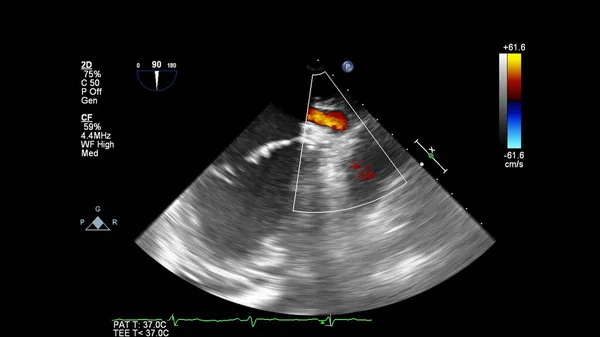 Immagine Del Cuore Durante Ecografia Transesofagea Con Modalità Doppler — Foto Stock