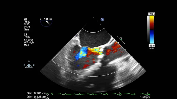 Transesofageal Ultrason Sırasında Doppler Kipi Ile Kalbin Görüntüsü — Stok fotoğraf