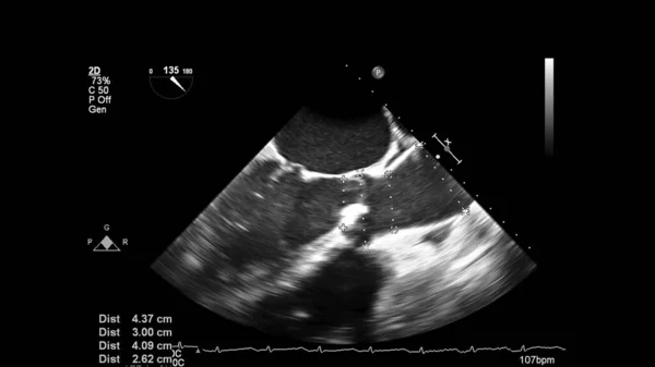 Image of the heart in gray-scale mode during transesophageal ultrasound.