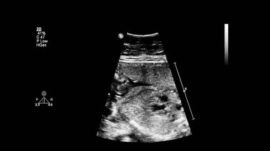 Fetal ekokardiyografi ile ultrasonografi ekranı