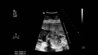 Fetal ekokardiyografi ile ultrasonografi ekranı