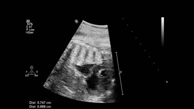 Fetal ekokardiyografi ile ultrasonografi ekranı