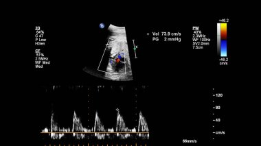 Fetal ekokardiyografi ile ultrasonografi ekranı