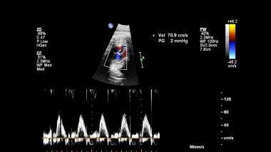 Fetal ekokardiyografi ile ultrasonografi ekranı