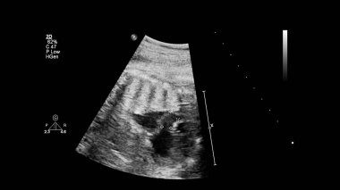 Fetal ekokardiyografi ile ultrasonografi ekranı