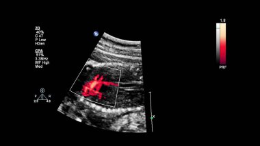 Fetal ekokardiyografi ile ultrasonografi ekranı