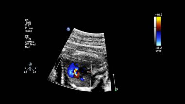 Fetal ekokardiyografi ile ultrasonografi ekranı