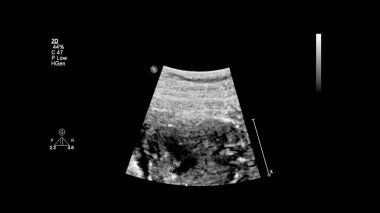 Fetal ekokardiyografi ile ultrasonografi ekranı