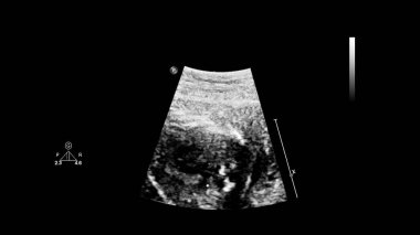 Fetal ekokardiyografi ile ultrasonografi ekranı