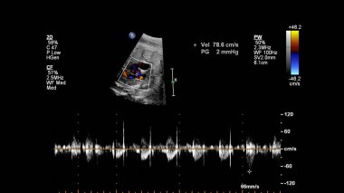 Fetal ekokardiyografi ile ultrasonografi ekranı