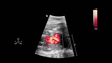 Fetal ekokardiyografi ile ultrasonografi ekranı