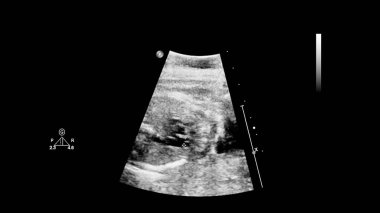 Fetal ekokardiyografi ile ultrasonografi ekranı