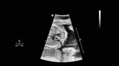 Fetal ekokardiyografi ile ultrasonografi ekranı