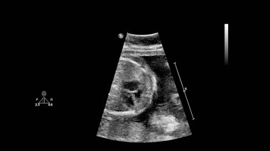Fetal ekokardiyografi ile ultrasonografi ekranı
