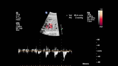 Fetal ekokardiyografi ile ultrasonografi ekranı