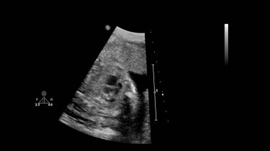 Fetal ekokardiyografi ile ultrasonografi ekranı