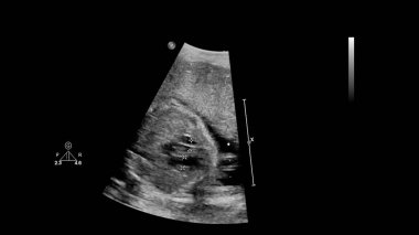 Fetal ekokardiyografi ile ultrasonografi ekranı
