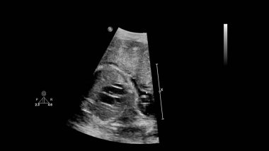 Fetal ekokardiyografi ile ultrasonografi ekranı