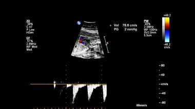 Fetal ekokardiyografi ile ultrasonografi ekranı