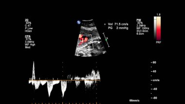 Fetal ekokardiyografi ile ultrasonografi ekranı