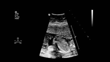 Fetal ekokardiyografi ile ultrasonografi ekranı
