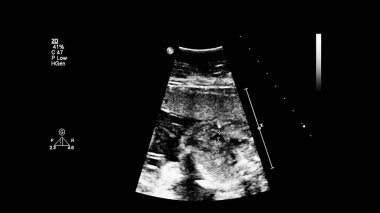 Fetal ekokardiyografi ile ultrasonografi ekranı