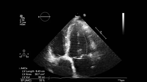 Image of the heart in gray-scale mode during transesophageal ultrasound.