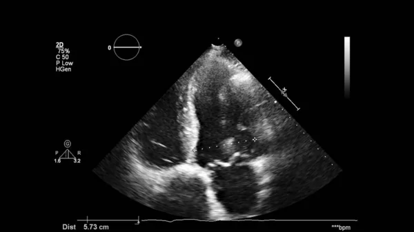 Image Cœur Mode Gris Lors Une Échographie Transœsophagienne — Photo