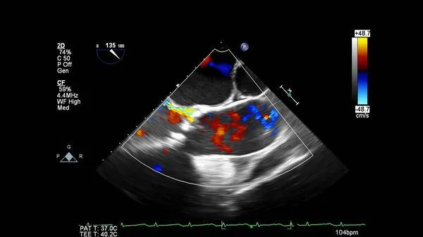 Imagem Coração Durante Ultrassom Transesofágico Com Modo Doppler — Fotografia de Stock