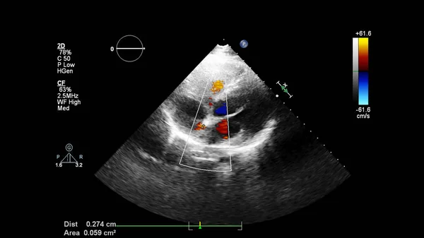 Bild Des Herzens Beim Transesophagealen Ultraschall Mit Doppler Modus — Stockfoto