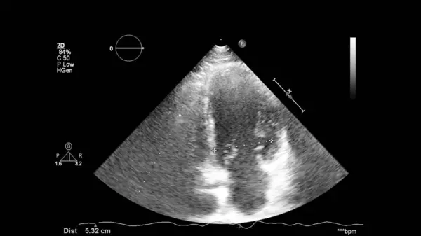 Image Cœur Mode Gris Lors Une Échographie Transœsophagienne — Photo