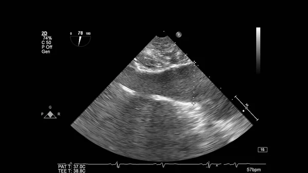 Image of the heart in gray-scale mode during transesophageal ultrasound.