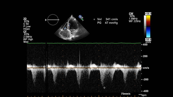Image of the heart during transesophageal ultrasound with Doppler mode.