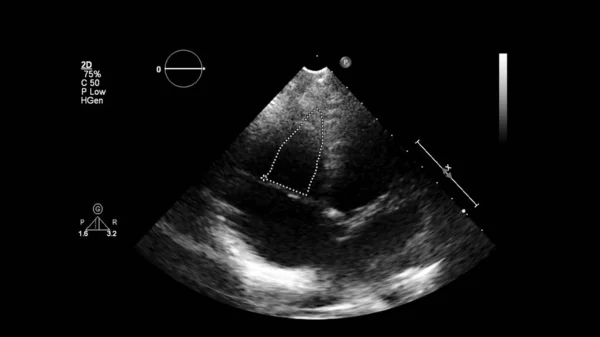 Transesofageal Ultrason Sırasında Kalbin Gri Ölçekli Görüntüsü — Stok fotoğraf