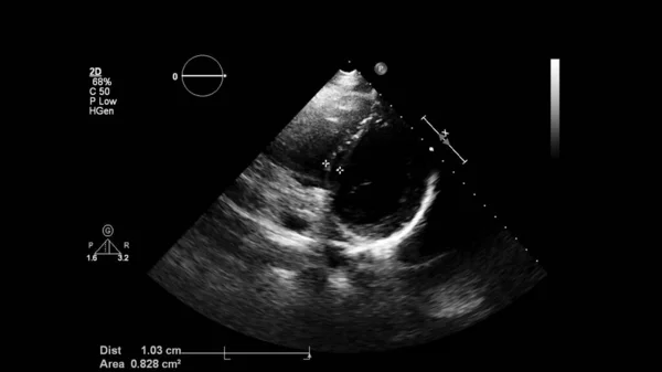 Transesofageal Ultrason Sırasında Kalbin Gri Ölçekli Görüntüsü — Stok fotoğraf