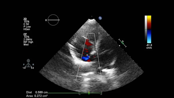 Изображение Сердца Время Трансофагеального Ультразвука Доплеровским Режимом — стоковое фото