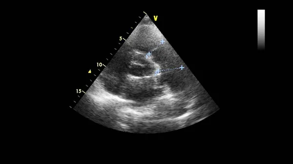 Image of the heart in gray-scale mode during transesophageal ultrasound.