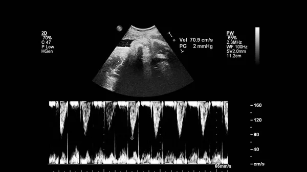 胎児心エコー検査付き超音波スクリーン — ストック写真