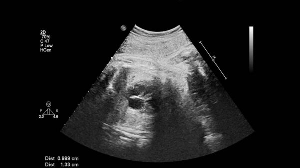 УЗИ с эхокардиографией плода
