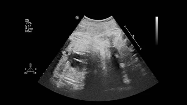 Ecrã Ultrassonográfico Com Ecocardiografia Fetal — Fotografia de Stock