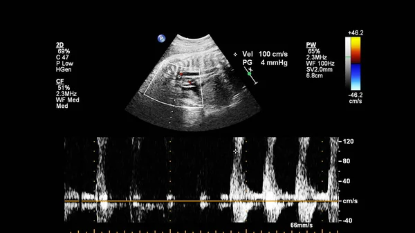 Schermo Ultrasuoni Con Ecocardiografia Fetale — Foto Stock