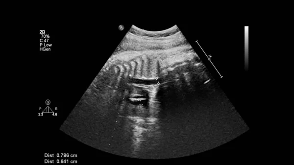 Ecrã Ultrassonográfico Com Ecocardiografia Fetal — Fotografia de Stock